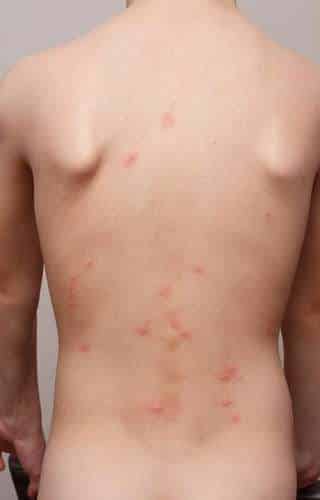 Longueur 2 : Piqûres d'insectes sur le dos d'une personne, image représentant une infestation d'acariens ou de punaises de lit.
