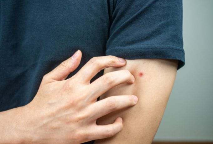 Tache de piqûre d'insecte sur le bras, insecte, allergie, réaction cutanée, infestation, prévention, extermination, SOS extermination, service pest control, traitement des nuisibles, élimination des parasites, expertise en extermination.